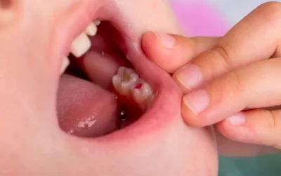 White or Silver? Picking the right filling for your child’s tooth